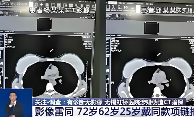 25岁72岁62岁三人CT片几乎一样