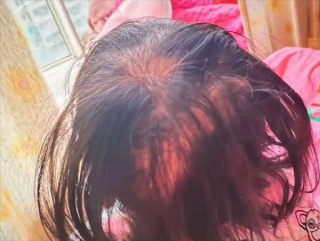 三岁女童眼神呆滞突发脱发，竟是铊中毒的警示信号