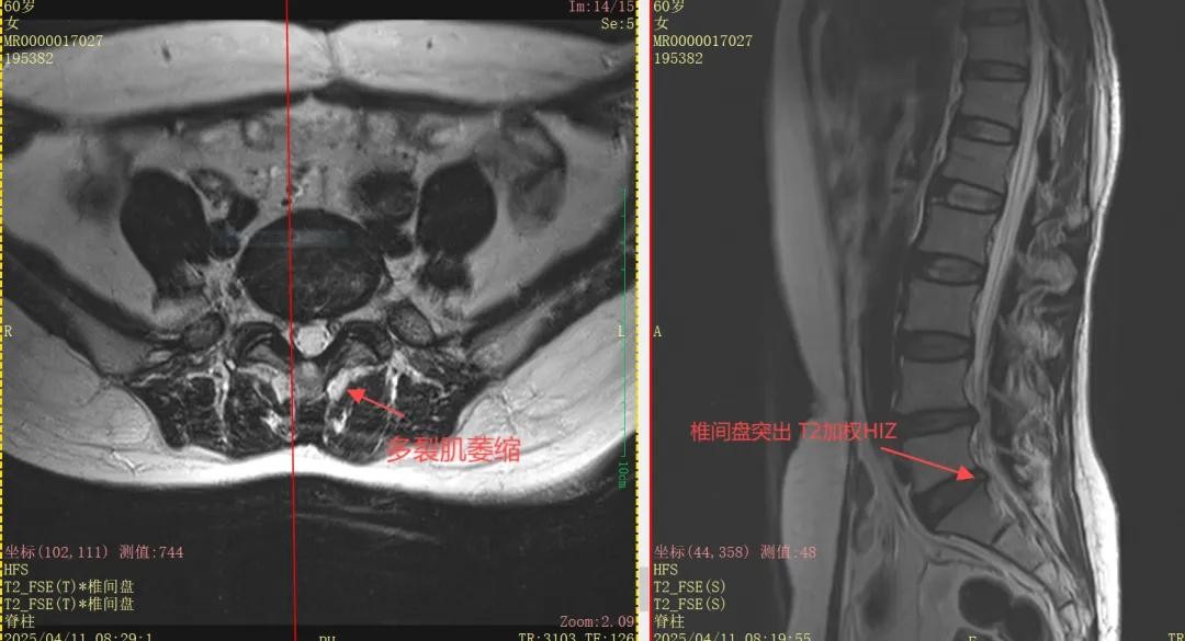 肌肉流失背后的隐形元凶揭秘，邦尔骨科团队守护脊柱健康之道  第5张